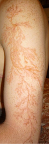 Lichtenberg Figures the color of dried blood run down her left side starting at her shoulder and going down to her foot. At her waist it forms the shape of a wing wrapping from her navel around to her spine.